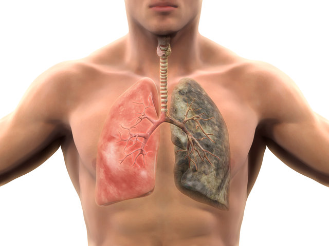 Akciğer Kanseri ve Tedavisi